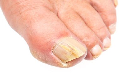 https://www.farnboroughfoothealth.co.uk/images/fungal_infections.jpg